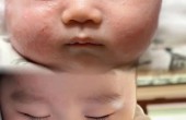 宝宝湿疹原因、区别及护理方法