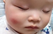 宝宝被蚊虫叮咬后怎样处理?