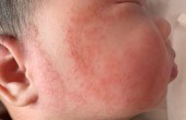 宝宝湿疹与热疹的区别